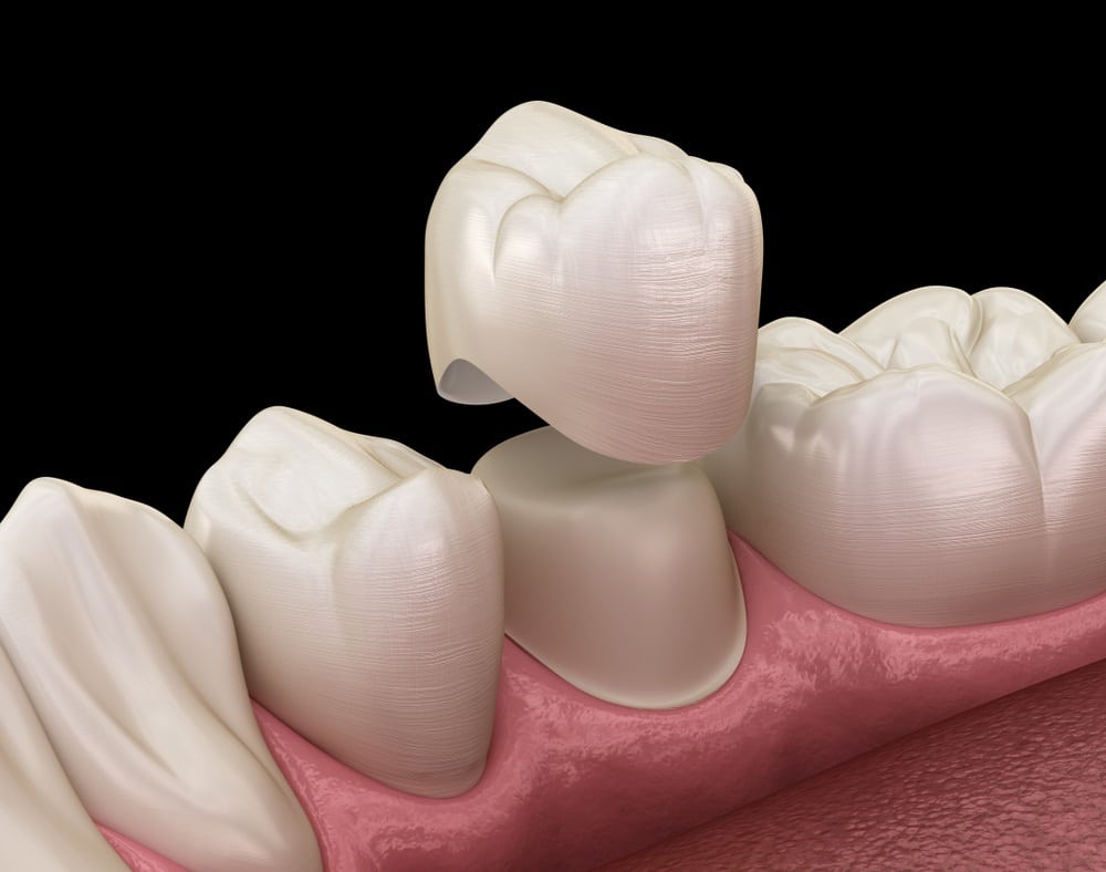 Inlay, Onlay, Filling, Crown and Implant: Which is the best option for you?