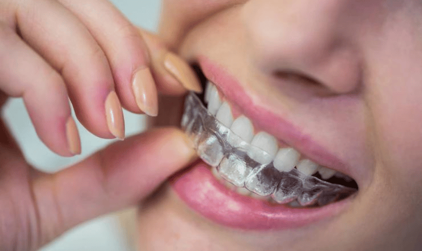 Invisalign treatment