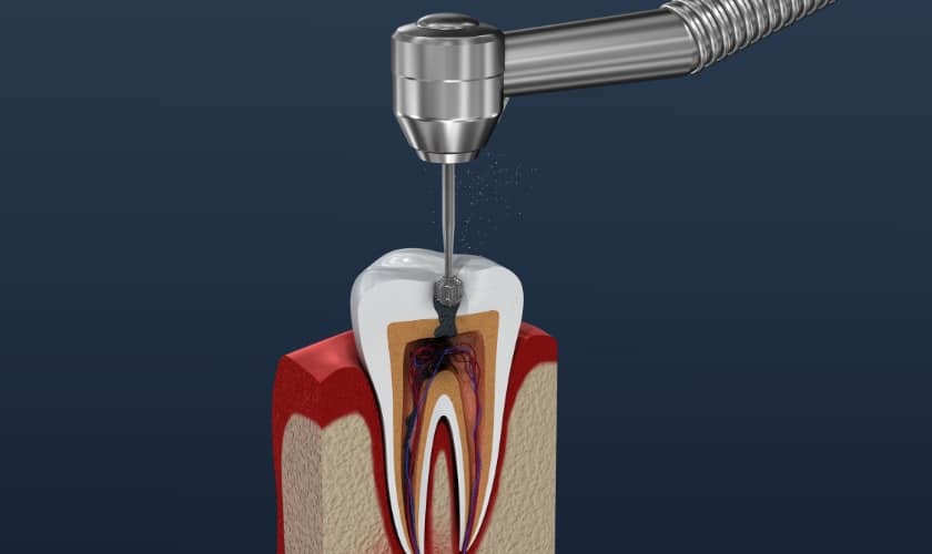 Root Canal Treatment Naperville