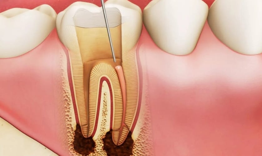 Root Canal Infection