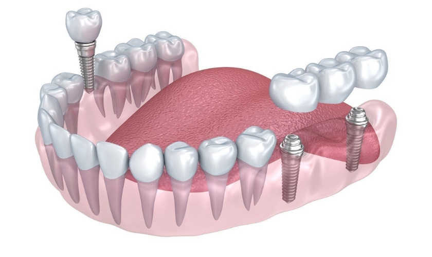 Dental Implant Problems And Solutions