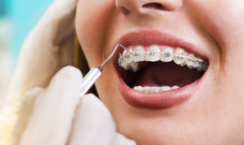 Fastest Braces Options for Adults