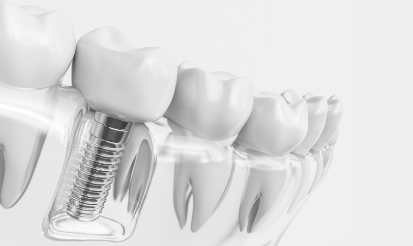 Smile Restoration with Dental Implants