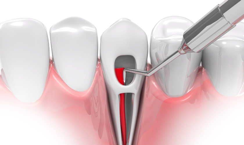 Toothache Conquering Root Canal Discomfort