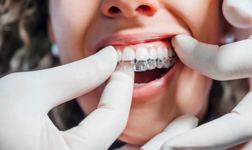 Prevent Stains on Your Invisalign Aligners