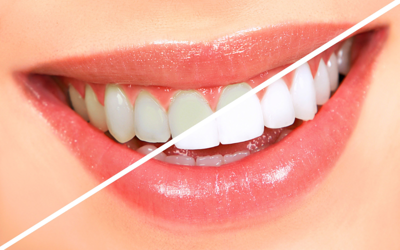 How Long Does Teeth Whitening Last
