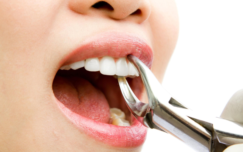Risks of avoiding tooth extraction