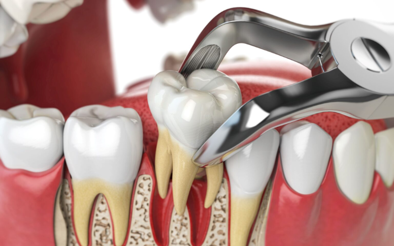 ear pain after tooth extraction