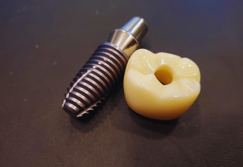 What Can You Eat After Dental Implant